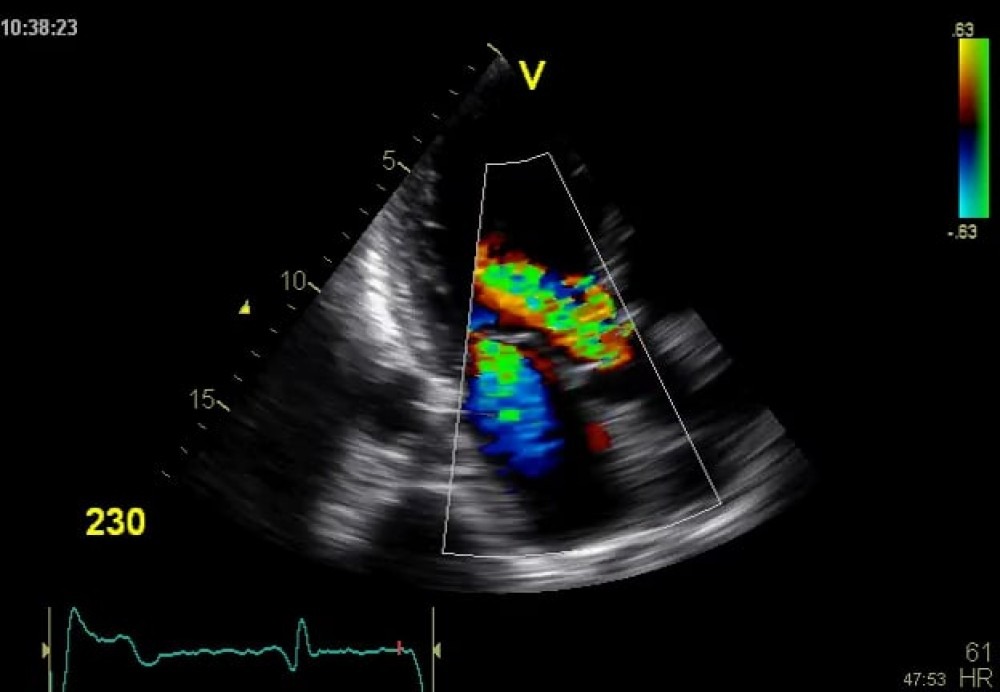 Best COLOR DOPPLER Test in Delhi
